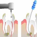 tecnica endodontica